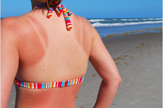 Can You Get A Sunburn In The Shade?