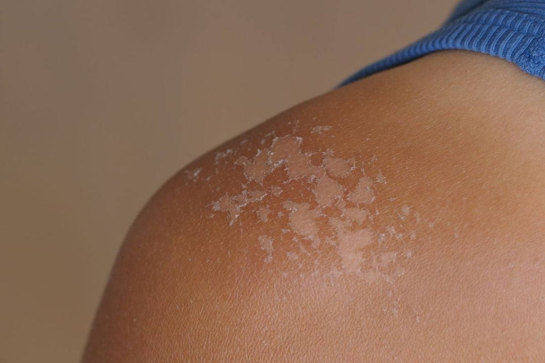 How To Prevent Sunburn Without Sunscreen